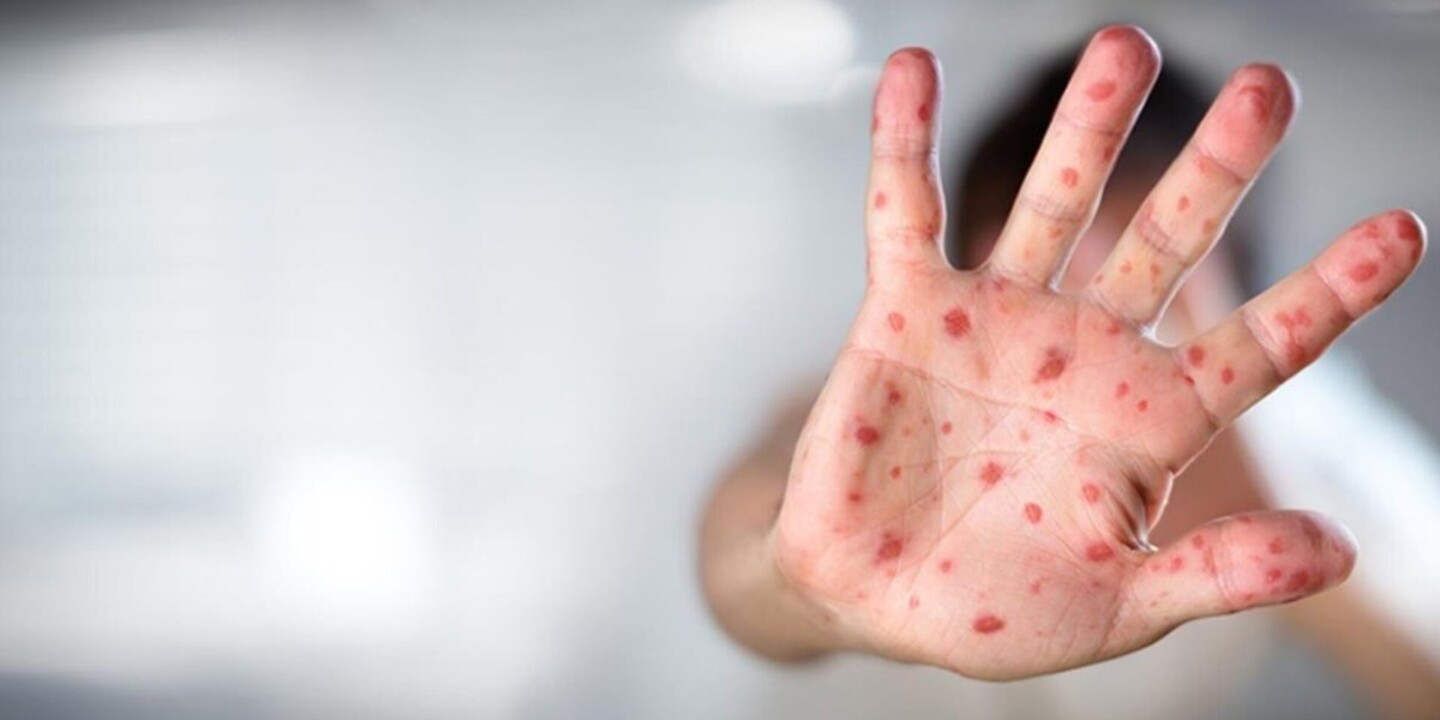 dsö maymun çiçeği virüsü açıklamaları