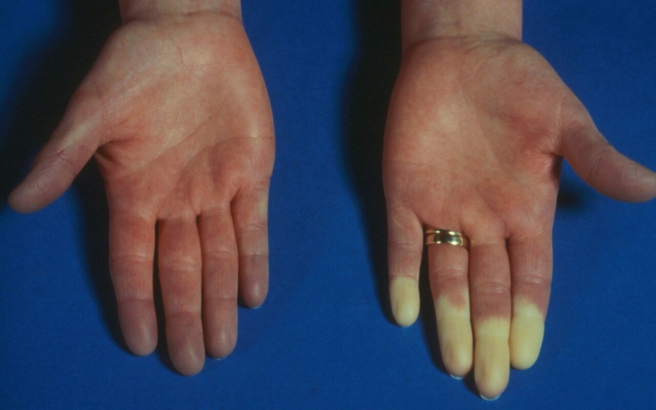 Raynaud Sendromu Nedir