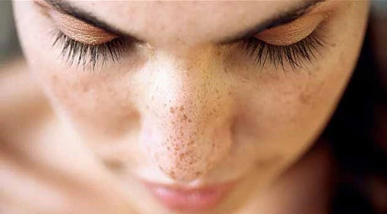 Güneş lekeleri bu renk ciltlerde daha sık görülüyor