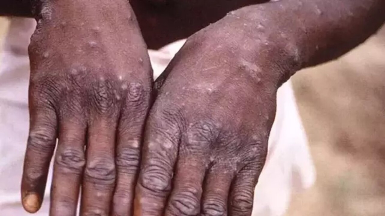 Mayısmun çiçeği cinsel yolla bulaşabiliyor