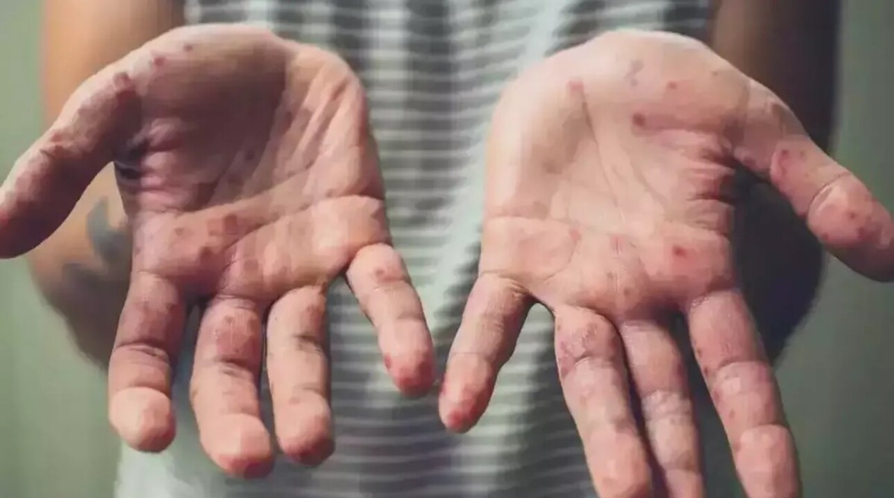 Mayısmun çiçeği cinsel yolla bulaşabiliyor