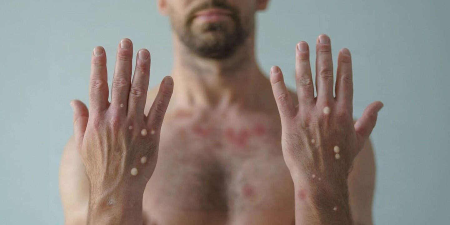 maymun çiçeği virüsü