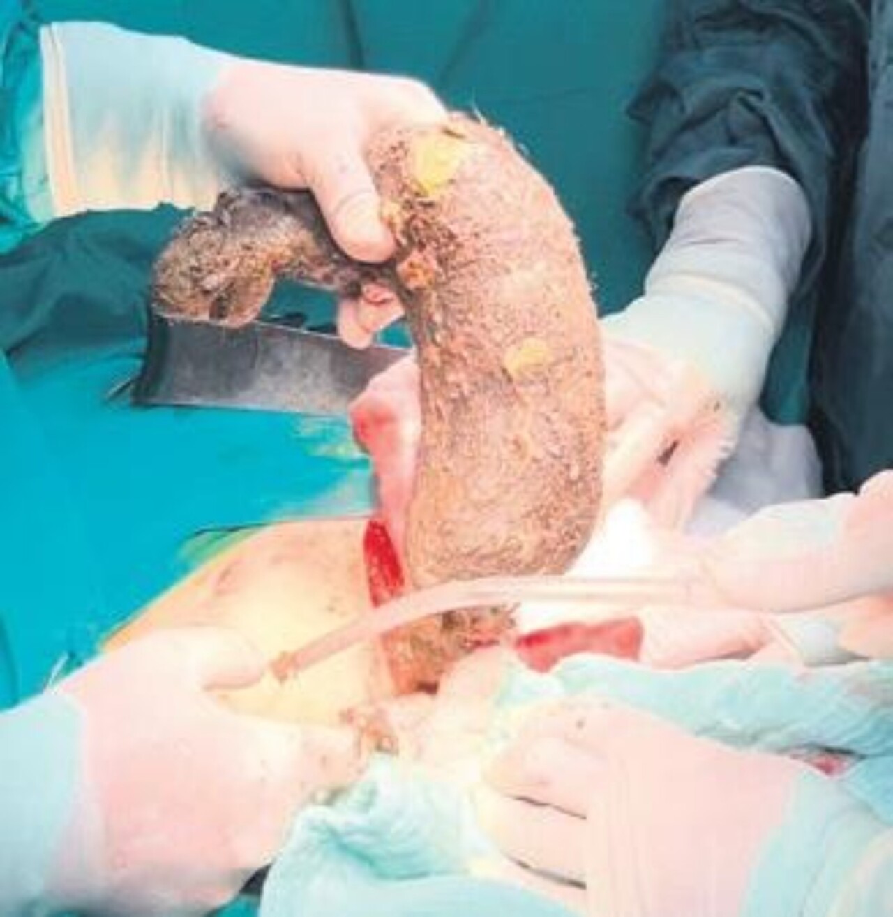 Midesinden 2 kilo kıl yumağı çıktı